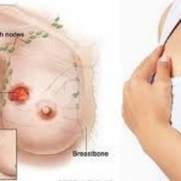 Cách tự phát hiện sớm ung thư vú