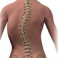 Tư thế ngồi học, cặp sách nặng có thế khiến bệnh cong vẹo cột sống ở trẻ em tiến triển nhanh