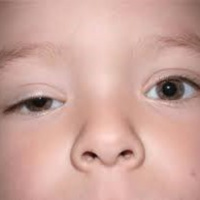 Sàng lọc trước sinh Hội chứng nhược cơ ở trẻ