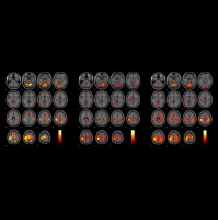 Bolezni možganov: izziv za družbo in znanost