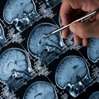 Alzheimers research puts focus on prevention