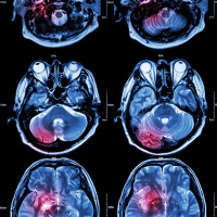 How can we best treat dementia?