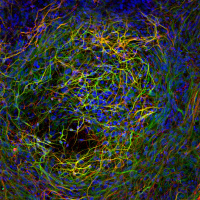 The difficult path to a cure for Alzheimers