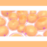 HH • The Unknown Disease Haunting Millions: LIPOEDEMA