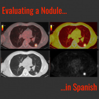 Evaluation of Lung Nodule – Review