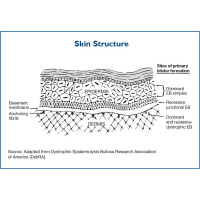 Epidermolysis Bullosa Explained in Laymans Terms