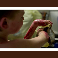 Special Guest Jodi Champagne Talks about her EB Awareness  Veterans Projects