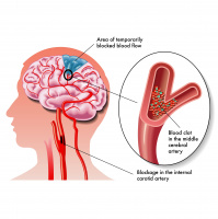 Episode #8 What is muscle testing and is it bogus? What kinds of things can be assessed using muscle testing? How to tell if your liver is congested. How to tell if you are at risk for stroke. How can you resolve IT band syndrome? Is there a cure for dand