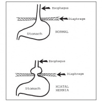 Is GERD, Reflux or Hiatal Hernia the REAL Problem?