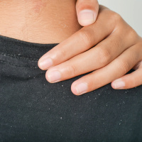 Flaky Scalps Have a Unique Fungal Microbiome