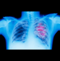 Lung Cancer Screen Could Be Easy Pee-sy