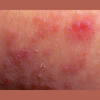 Bacteria Might Share the Blame for Eczema