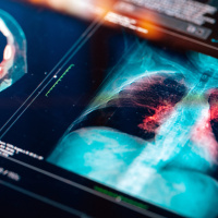 Engineering the Treatment of Early-Stage Lung Cancer [SPONSORED]