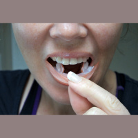 Whitening Strips Alter Proteins in Teeth