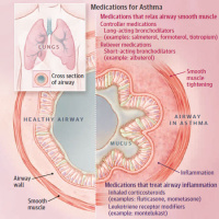 Asthma Guidelines Update 2020 - Diagnosis and Management