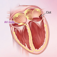 USPSTF Recommendation: Screening for Atrial Fibrillation