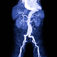 USPSTF Recommendation: Screening for Abdominal Aortic Aneurysm