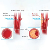 USPSTF Recommendation: Carotid Artery Stenosis