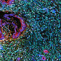 USPSTF Recommendation: Screening for Pancreatic Cancer