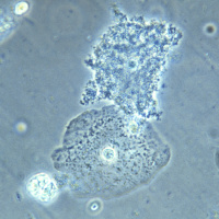 USPSTF Recommendation: Screening for Bacterial Vaginosis to Prevent Preterm Delivery