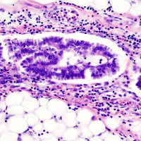 USPSTF Recommendation: Screening for Ovarian Cancer