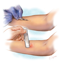 USPSTF Recommendation: Screening for Latent Tuberculosis in Adults