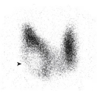 Screening for Thyroid Cancer