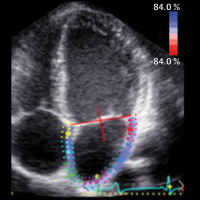 Examining the Association of Left Atrial Function and Size With Incident Dementia