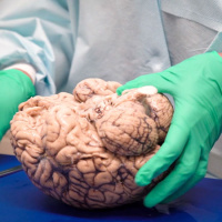 Evaluation of Chronic Traumatic Encephalopathy in Football Players