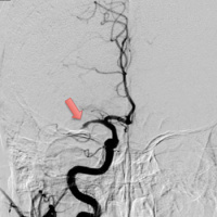 Endovascular Thrombectomy and Outcomes in Ischemic Stroke