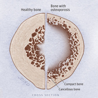 USPSTF Recommendation Statement: Screening for Osteoporosis to Prevent Fractures