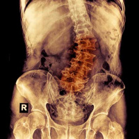 USPSTF Recommendation: Screening for Adolescent Idiopathic Scoliosis