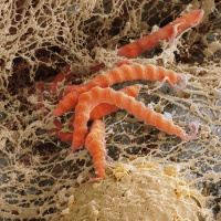 Barry Marshall, MD: H pylori 35 Years Later