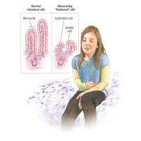 Screening for Celiac Disease