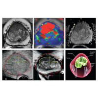 Patient-Reported Outcomes Following Treatment for Localized Prostate Cancer