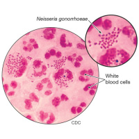 USPSTF Recommendation: Screening for Chlamydia and Gonorrhea