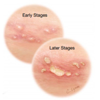 Serologic Screening for Genital Herpes Infection