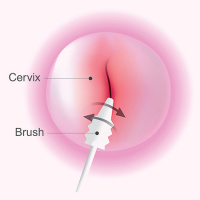 USPSTF Recommendation: Screening for Cervical Cancer