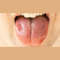 317. Oral Cavity Cancer