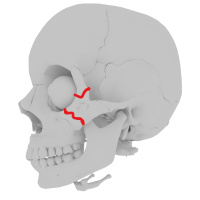 398. Orbital Fracture