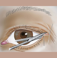 423. Ocular Trauma 1: Lid Lacerations and Orbital Compartment Syndrome