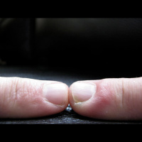 402. Felon Infection