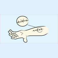 219. Necrotizing Fasciitis