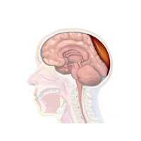 314. Epidural Hematoma