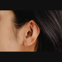 412. Tympanic Membrane Perforations