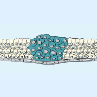 87. Principles of Cancer Surgery VI: Cancer Recurrence