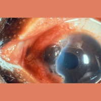 424. Ocular Trauma 2: Intraocular Foreign Bodies and Globe Rupture