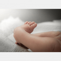 341. Clubfoot - Congenital Talipes Equinovarus (CTE)