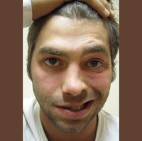 406. Facial Nerve Palsy Part 1