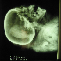 The Mystery of the Disappearing Mystery Disease in New Brunswick